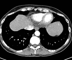 Washout of Hemangioma - CTisus CT Scan