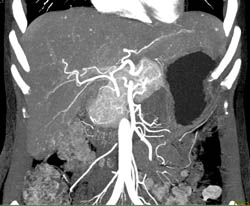 Granulomas in Liver and Spleen - CTisus CT Scan