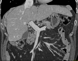 Carcinoid With Implant on Liver and Spleen - CTisus CT Scan