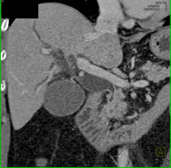 Dilated Gb and Top Normal SMA - CTisus CT Scan