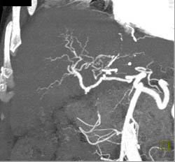 Neovascularity Liver - CTisus CT Scan