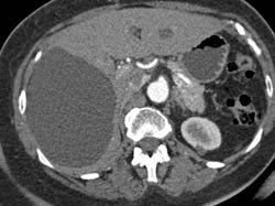 Simple Cyst Liver - CTisus CT Scan