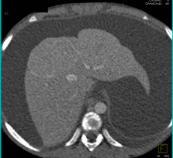 Cirrhosis With Abnormal Vessels- See Sequence - CTisus CT Scan