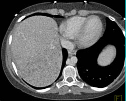 Infection Due to Tuberculosis (TB) in the Liver- Microabscesses - CTisus CT Scan