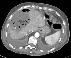 Liver Abscess - CTisus CT Scan