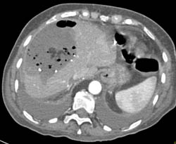 Liver Abscess - CTisus CT Scan