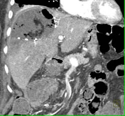 Liver Abscess - CTisus CT Scan