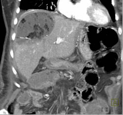 Liver Abscess - CTisus CT Scan