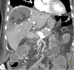 Liver Abscess - CTisus CT Scan