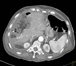 Liver Abscess - CTisus CT Scan