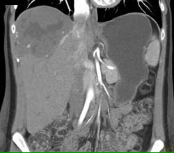 Giant Hemangioma - CTisus CT Scan