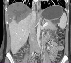 Giant Hemangioma - CTisus CT Scan