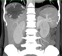 Giant Hemangioma - CTisus CT Scan