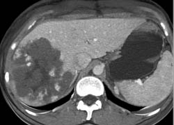 Giant Hemangioma - CTisus CT Scan