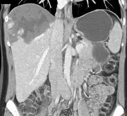 Giant Hemangioma - CTisus CT Scan