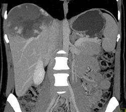 Giant Hemangioma - CTisus CT Scan