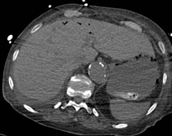 Air in Portal Vein With Emphysematous Gastritis - CTisus CT Scan