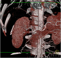 Patent SMA and Celiac Artery - CTisus CT Scan