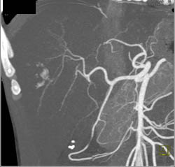 Hemangioma - CTisus CT Scan