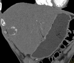 Hemangioma - CTisus CT Scan