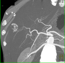 Hemangioma - CTisus CT Scan