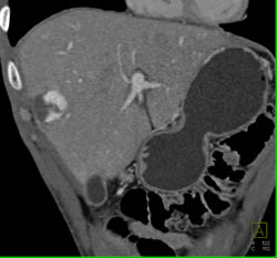 Hemangioma - CTisus CT Scan