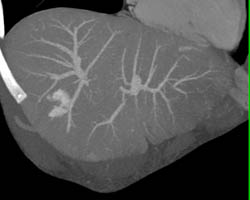 Hemangioma - CTisus CT Scan