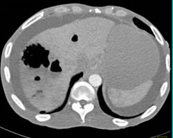 Liver Abscess - CTisus CT Scan