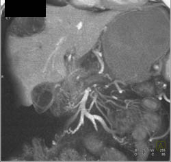 Ascending Cholangitis With Liver Abscess - CTisus CT Scan