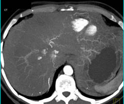 Hemangioma - CTisus CT Scan