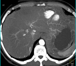 Hemangioma - CTisus CT Scan