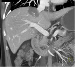 Hemangioma - CTisus CT Scan