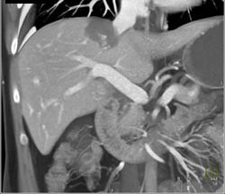 Hemangioma - CTisus CT Scan