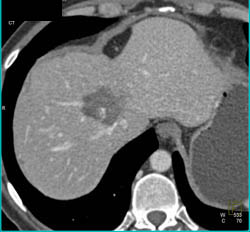 Hemangioma - CTisus CT Scan