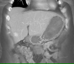 Focal Nodular Hyperplasia (FNH) - CTisus CT Scan