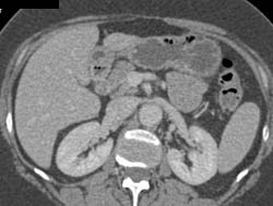 Focal Nodular Hyperplasia (FNH) - CTisus CT Scan