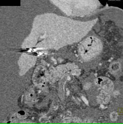 Cirrhosis - CTisus CT Scan