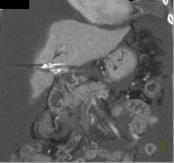 Cirrhosis - CTisus CT Scan