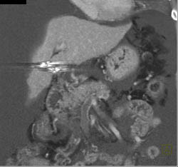 Cirrhosis - CTisus CT Scan