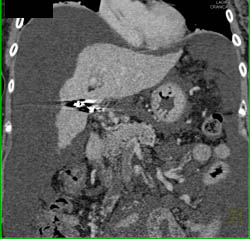 Cirrhosis - CTisus CT Scan