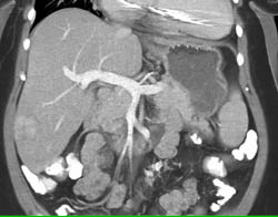 Hepatic Adenoma - CTisus CT Scan