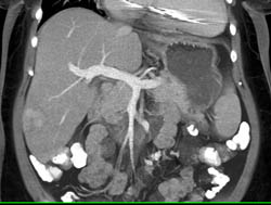 Hepatic Adenoma - CTisus CT Scan