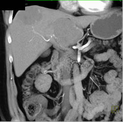 Hemangioma - CTisus CT Scan