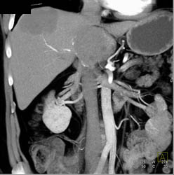 Hemangioma - CTisus CT Scan