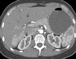 Focal Nodular Hyperplasia (FNH) - CTisus CT Scan