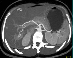 Focal Nodular Hyperplasia (FNH) - CTisus CT Scan