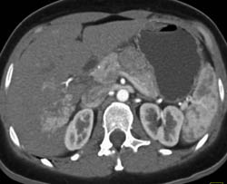 Focal Nodular Hyperplasia (FNH) - CTisus CT Scan