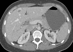 Hemangioma and Focal Nodular Hyperplasia (FNH) - CTisus CT Scan