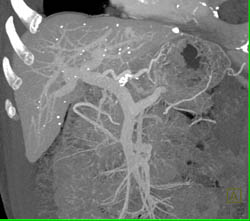 Liver Granulomatous Disease - CTisus CT Scan