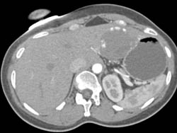 Hemangioma Over Time in 3D Renderings - CTisus CT Scan